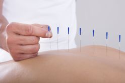 Acupuncture needles in person's back